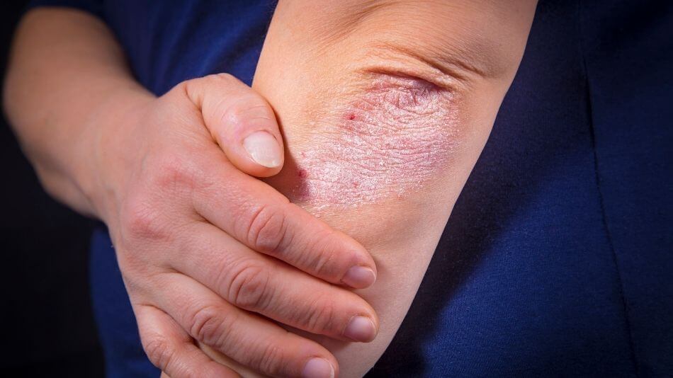 Women with eczema on her elbow.