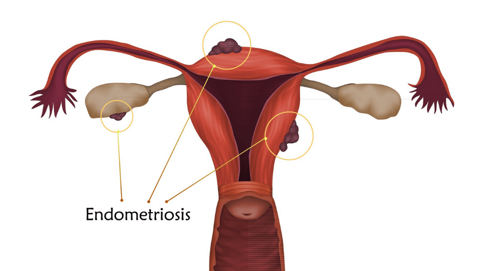 Diagram explaining what endometriosis is.