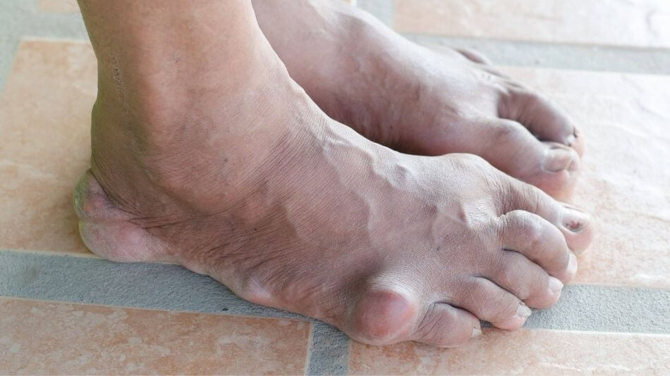 Feet that are riddled with gout.