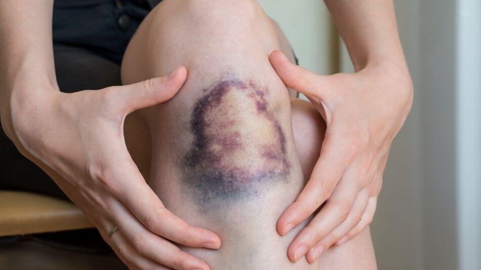 Massive bruise under someones knee.