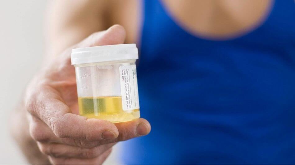 Older women with dry hands holding out a lab test cup filled with urine.